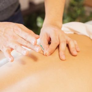 From above of crop anonymous man applying needles on back of client during acupuncture procedure